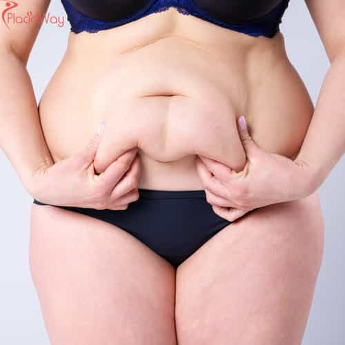 Tummy Tucks and Breast Lifts: The Perfect Mommy Makeover in Colombia